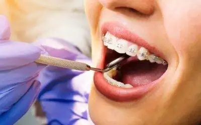 Dental Braces and It’s types, Braces cost and braces treatment in Houston