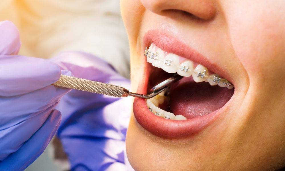 Dental Braces and It's types, Braces cost and braces treatment in Houston